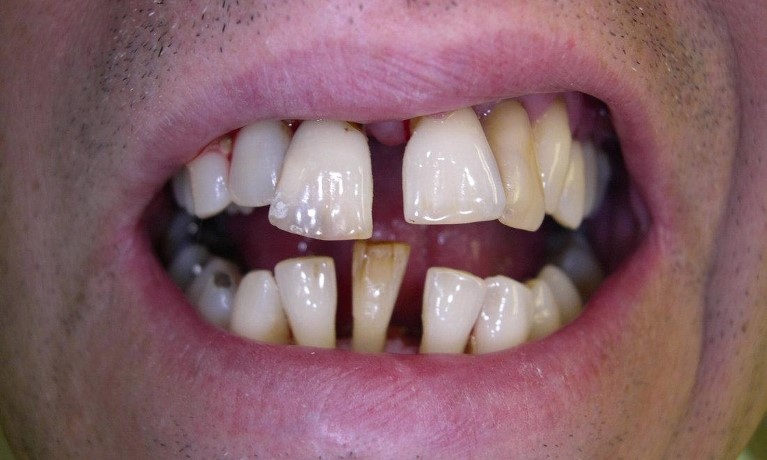 Permanent Dentures Procedure Austin TX 78751